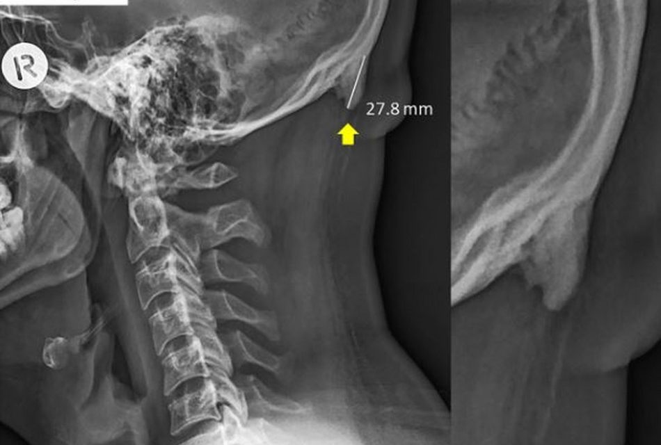 Cientistas dizem que uso de celular pode criar protuberância no crânio