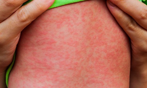 Formiga: Resultado de teste para sarampo em bebê é negativo