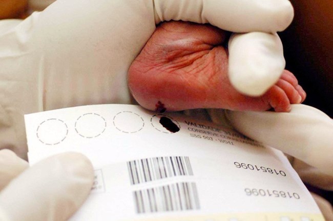 Teste do pezinho em Minas identifica, pela primeira vez, bebê com imunodeficiência combinada grave
