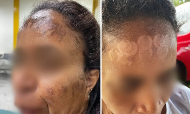 Após lesões por laser em clínica, professora desabafa: ‘Rosto queimado e sem poder sair’