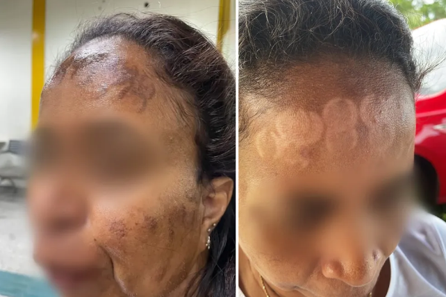 Após lesões por laser em clínica, professora desabafa: ‘Rosto queimado e sem poder sair’