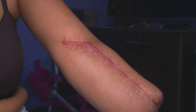 Mulher vai a hospital para dar à luz e sai com mão amputada