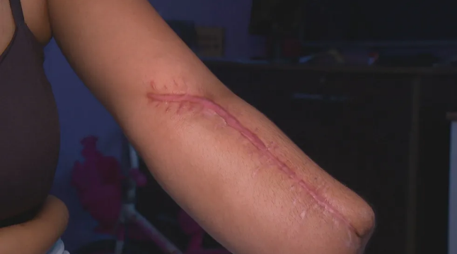 Mulher vai a hospital para dar à luz e sai com mão amputada