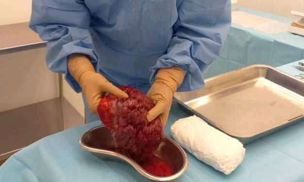 Pesquisa desenvolve curativos biológicos à base de placenta