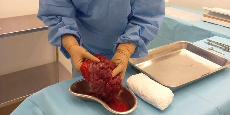 Pesquisa desenvolve curativos biológicos à base de placenta