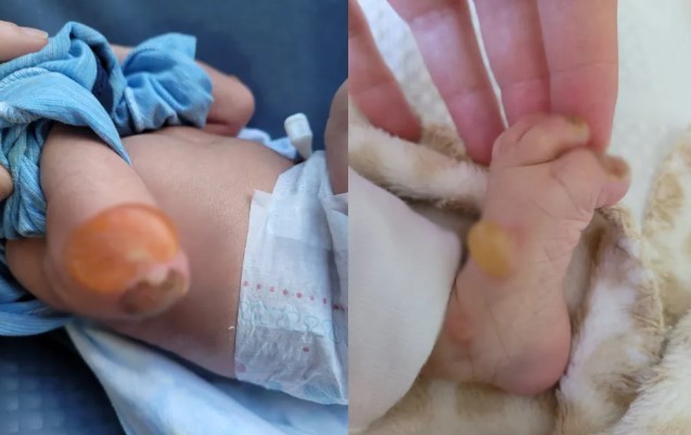 Morre bebê diagnosticado com doença rara que torna pele tão frágil quanto asas de borboleta
