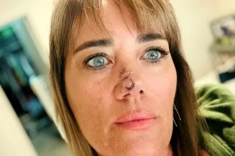 Mulher confunde caroço no rosto com espinha e descobre câncer de pele avançado