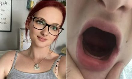 Jovem de 26 anos arranca todos os dentes após vomitar nos 9 meses da gravidez