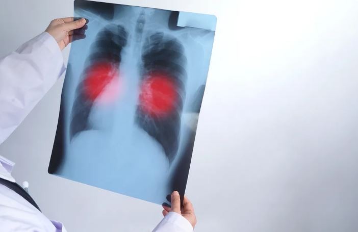 Passos já registrou três mortes e 28 casos de tuberculose em 2023