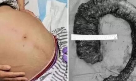 Mulher faz cirurgia para retirar cocô gigante de 1 metro e 20 kg do intestino