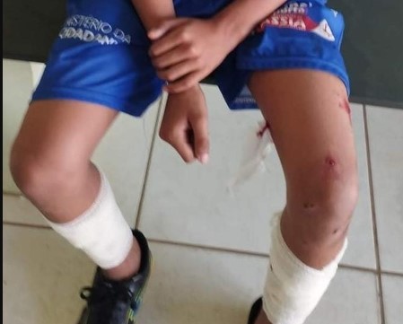 Criança é atacada por pitbull em Cássia, no Sul de Minas