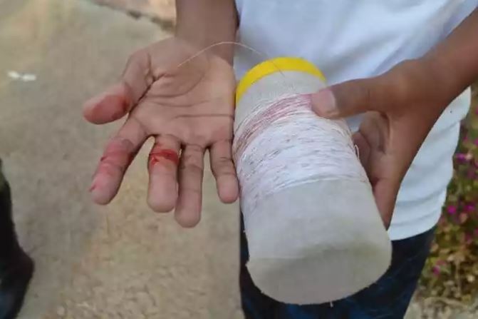 Menino de 9 anos é atingido por linha chilena e fica em estado grave