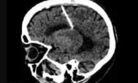 Idosa faz tomografia e descobre agulha de 3 cm enfiada no cérebro