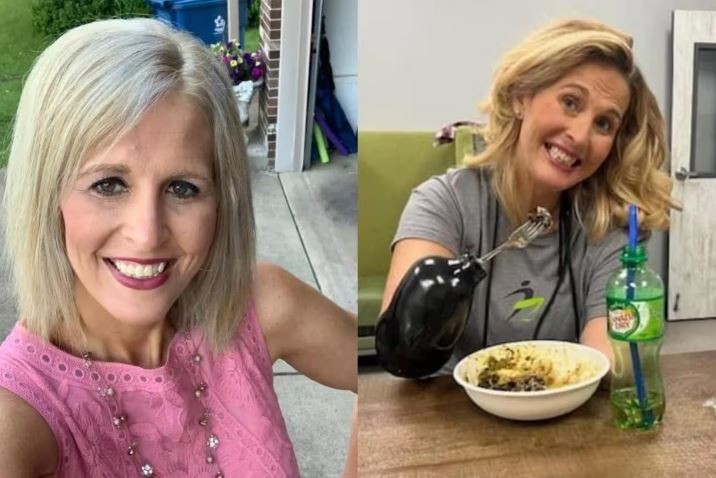 Gripe forte leva mulher de 42 anos a amputar pés e braços