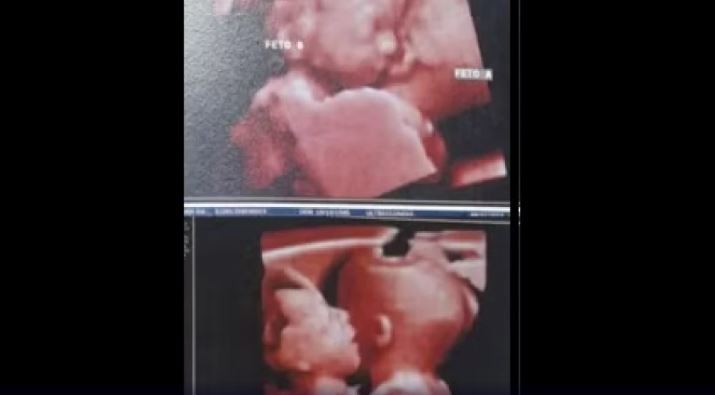 Grávida de gêmeas descobre que filhas siamesas dividem apenas um coração