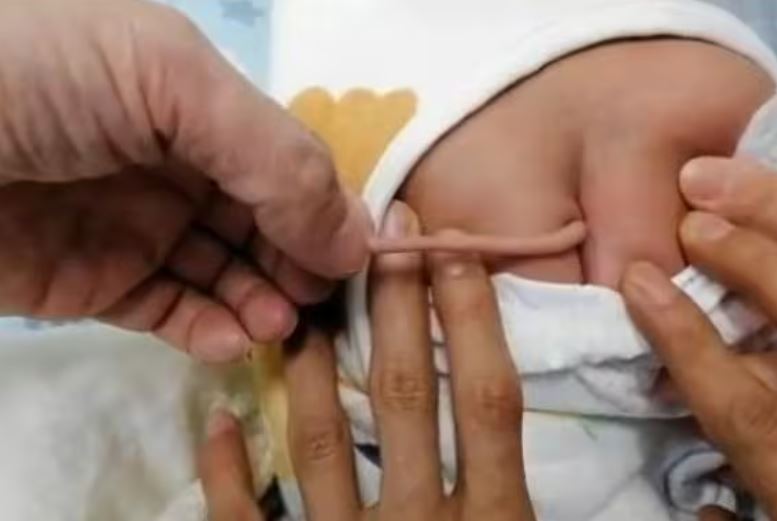 Bebê nasce com ‘cauda’ de 10 centímetros; conheça a causa da anomalia