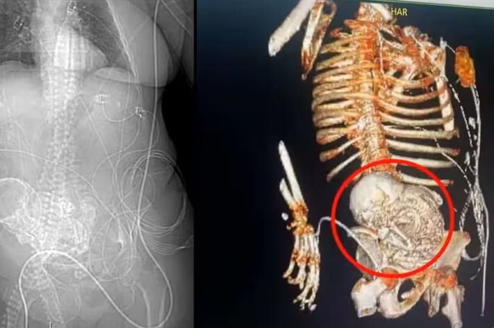 Idosa que carregava feto calcificado por 56 anos morre após cirurgia para retirada