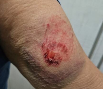 Professora é mordida por aluno em escola no bairro Nações em Divinópolis
