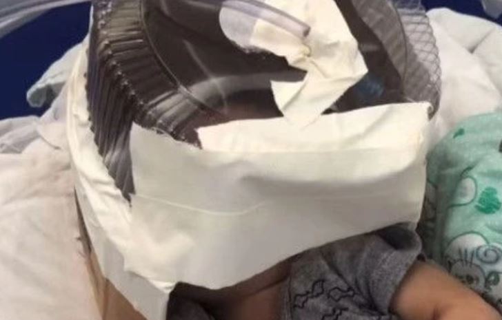 Hospital usa embalagem de bolo como máscara de oxigênio em bebê com bronquiolite
