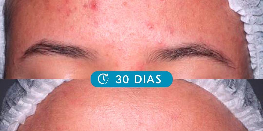 Tecnologia de combate à acne desenvolvida pela UFMG passa em teste clínico e chega ao mercado