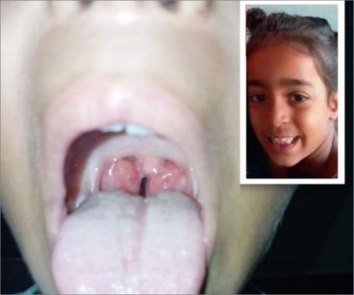 Vaquinha Solidária busca recursos para ajudar na cirurgia da garota Kerolly