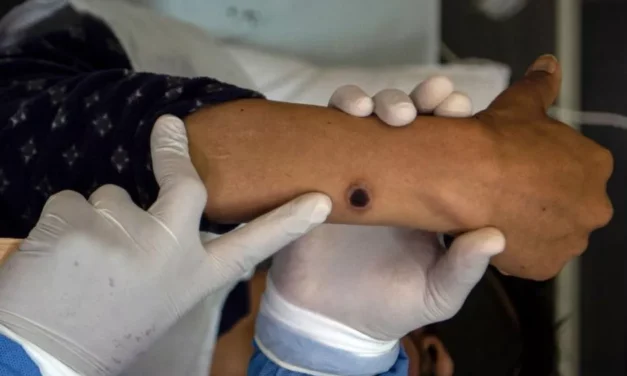Mpox: SP confirma primeiro caso brasileiro de nova cepa responsável por surto na África