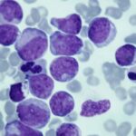 Novo estudo descobre como proteína afeta crescimento de células de câncer