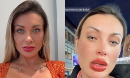 Andressa Urach pede orações após cirurgia para mudar cor dos olhos: ‘urgente’