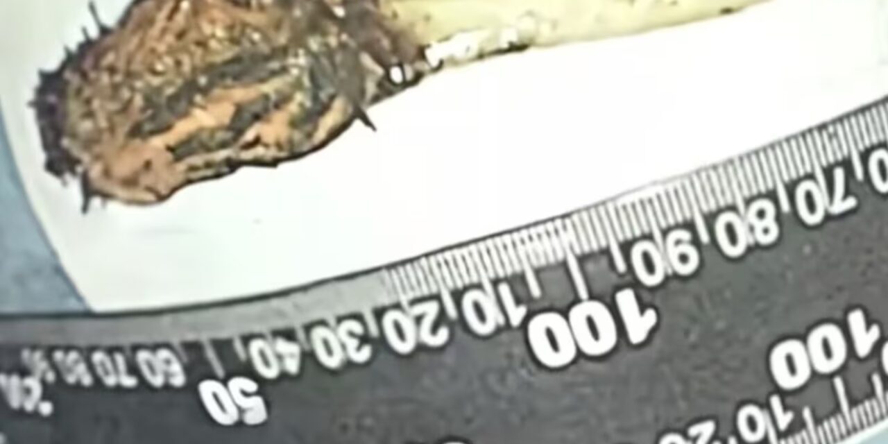 Homem descobre que escova de dente engolida na infância estava presa no intestino há 52 anos