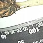 Homem descobre que escova de dente engolida na infância estava presa no intestino há 52 anos