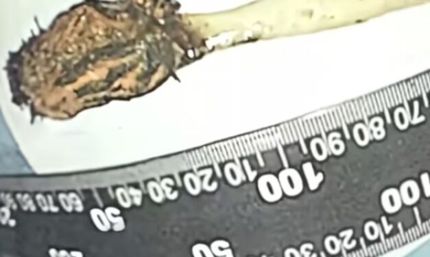 Homem descobre que escova de dente engolida na infância estava presa no intestino há 52 anos