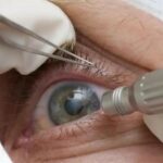 Cirurgia que altera cor do olho tem uso restrito para pessoas cegas