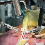Robô faz cirurgia orientado por IA e sem nenhuma assistência humana