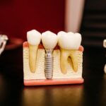 Diabéticos podem realizar implantes dentários? Descubra os exames e cuidados essenciais