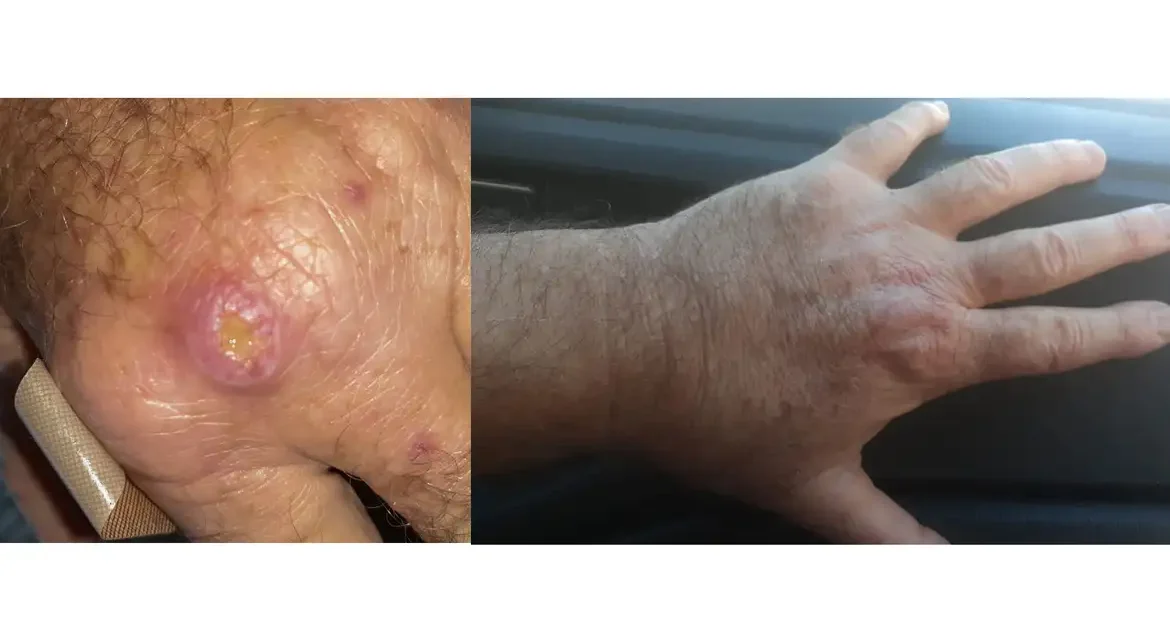Especialistas apontam desconhecimento como obstáculo no combate à leishmaniose
