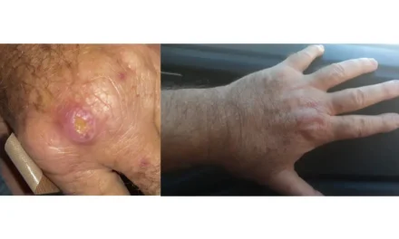 Especialistas apontam desconhecimento como obstáculo no combate à leishmaniose