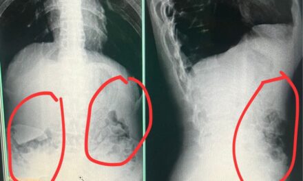 Detentos são flagrados tentando retornar ao presídio com drogas no estômago em Governador Valadares