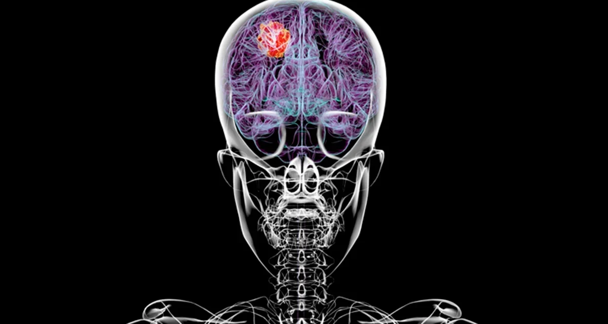 Estudo revela que glioblastoma afeta o corpo além do cérebro e compromete sistema imunológico