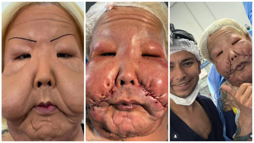 Juju do Pix inicia nova fase com cirurgia que remove tecido afetado por óleo mineral