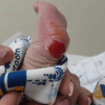 Secretaria de Saúde investiga queimadura em recém-nascido durante teste do pezinho em Piumhi