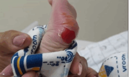 Secretaria de Saúde investiga queimadura em recém-nascido durante teste do pezinho em Piumhi