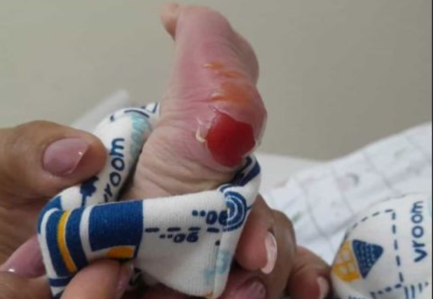 Secretaria de Saúde investiga queimadura em recém-nascido durante teste do pezinho em Piumhi
